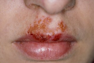 Light brown impetigo blisters between mouth and nose