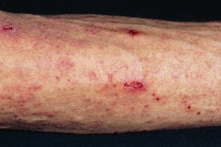 An arm with a red rash of small scabies spots