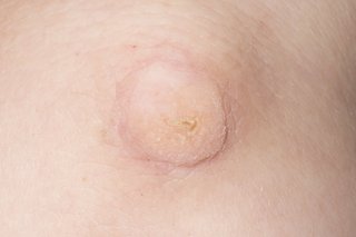 A small, pale lump on skin (a wart)