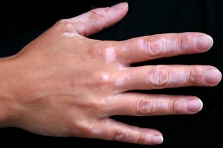 A hand with vitiligo patches of pale skin on the fingers and back of the hand