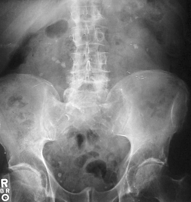 Kidney_stones_abdominal_X-ray