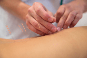 Acupuncture treatment on back