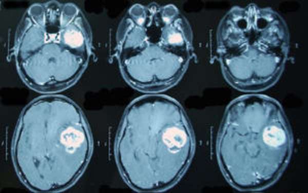 Снимок мозга МРТ