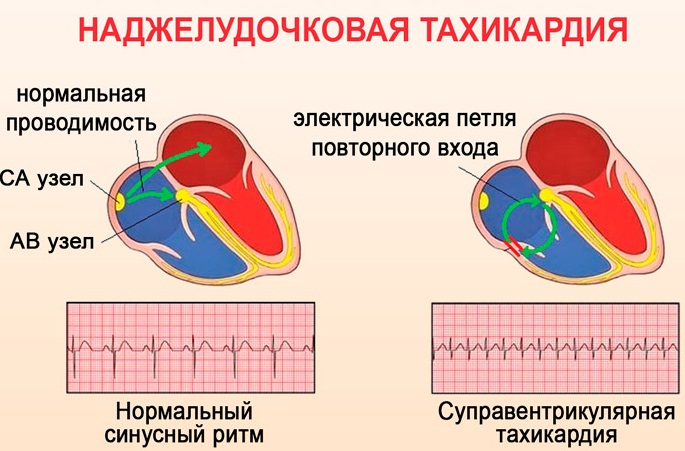 Сероводородные ванны. Показания и противопоказания, польза и вред, отзывы врачей. Пятигорск, Мацеста, Абхазия, Гагра