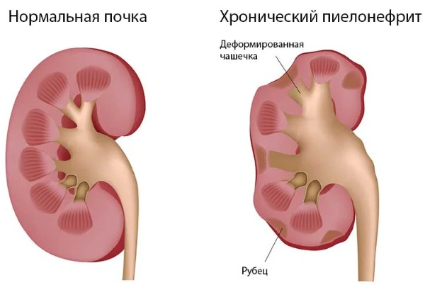 Продукты полезные для почек и вредные при беременности, диабете, пиелонефрите, воспалении, камнях