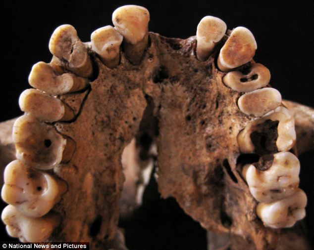 Multiple incidents of dental cavities and other oral diseases affected the upper teeth of these 15,000-year-old remains, recovered from Grotte des Pigeons at Taforalt in Morocco