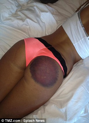Ouch: Dickson is suing Playboy and the radio DJ who caused this bruise after hitting her right buttock