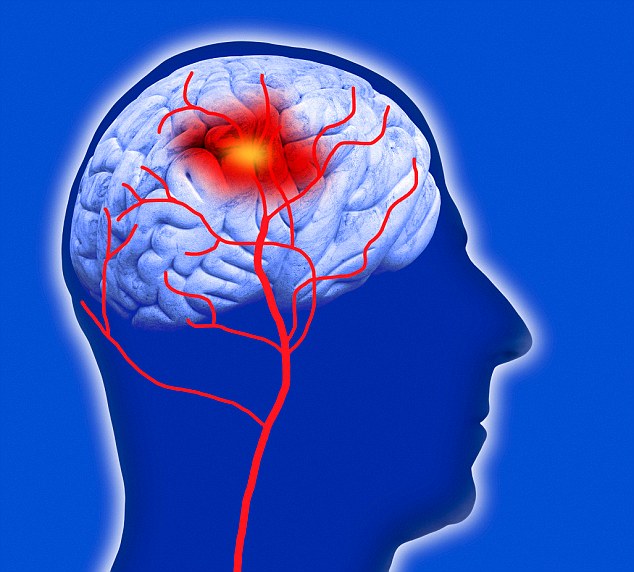 The study suggested both insomnia and oversleeping may raise the risk of stroke (pictured in artwork), where the blood supply to the brain is cut off, and hamper recovery afterwards