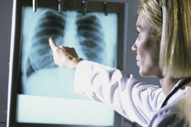 Female doctor pointing at a chest X-ray