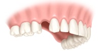 dental implant indication : single unit toothless gap