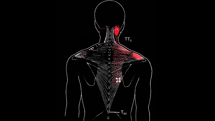 триггерные точки в нижней части трапециевидной мышцы
