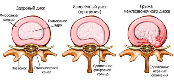 Грыжа межпозвоночного диска