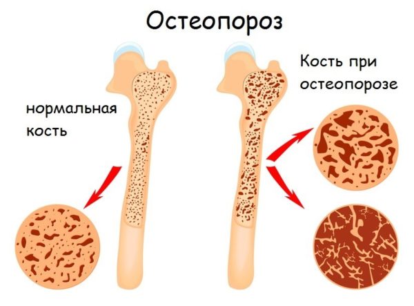 Остеопороз 