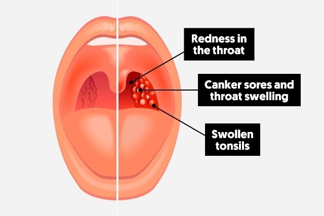 Healthy throat vs sore throat