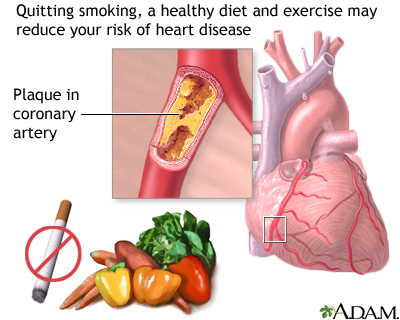 Prevention of heart disease