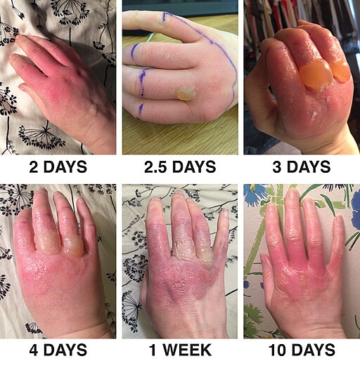 Phytophotodermatitis from exposure to lime juice