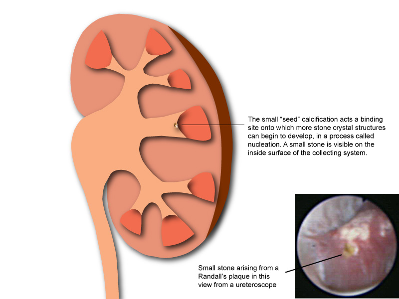 Early development of a kidney stone