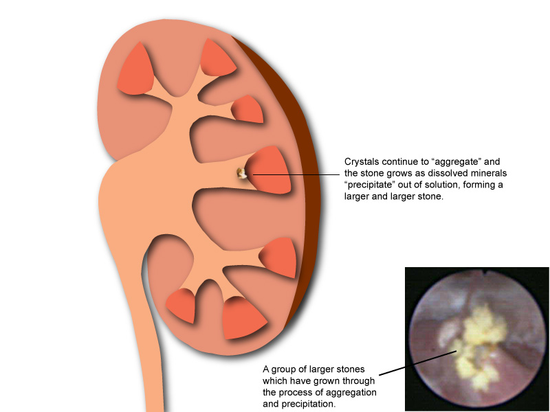 Growth of a kidney stone